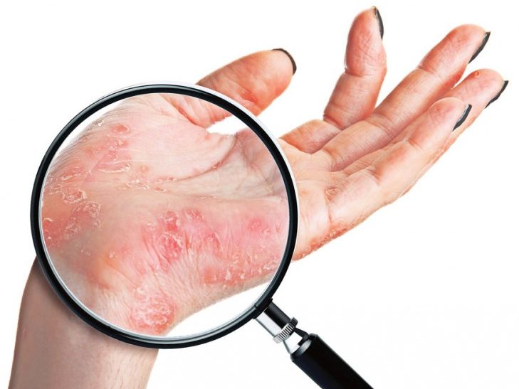 Псориазом страдает до 5% населения планеты