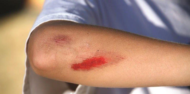 Гемофилия у взрослых: как сохранить суставы и избежать осложнений