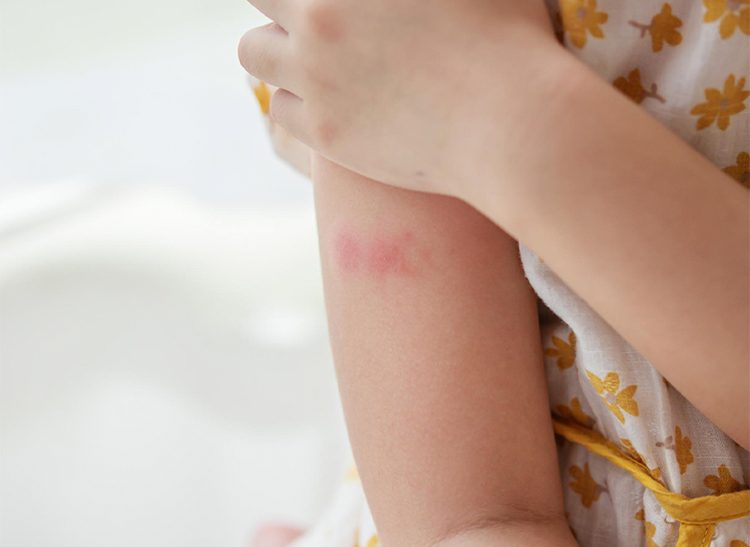 Атопический дерматит: причины возникновения и профилактика